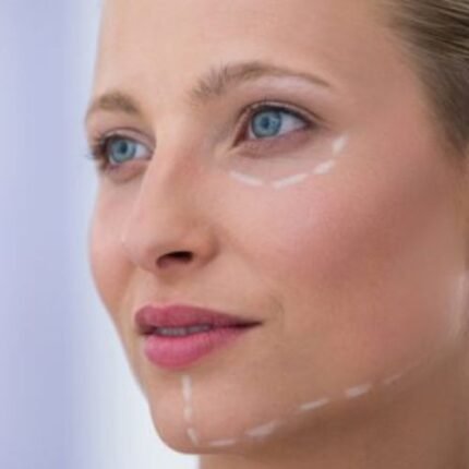 Lifting Facial em Curitiba Cirurgia Deep Plane em Curitiba