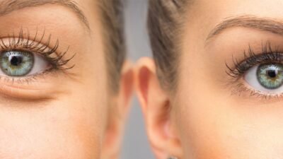 Resgate seu olhar através da Blefaroplastia