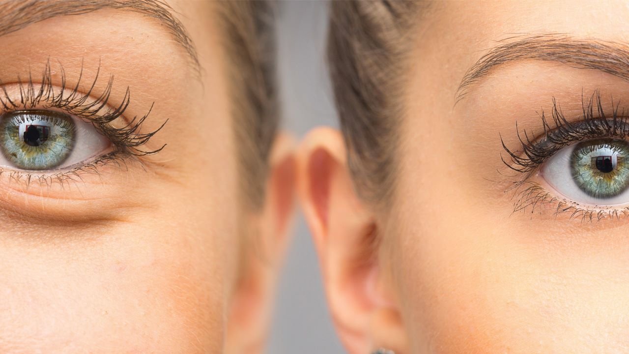 Resgate seu olhar através da Blefaroplastia